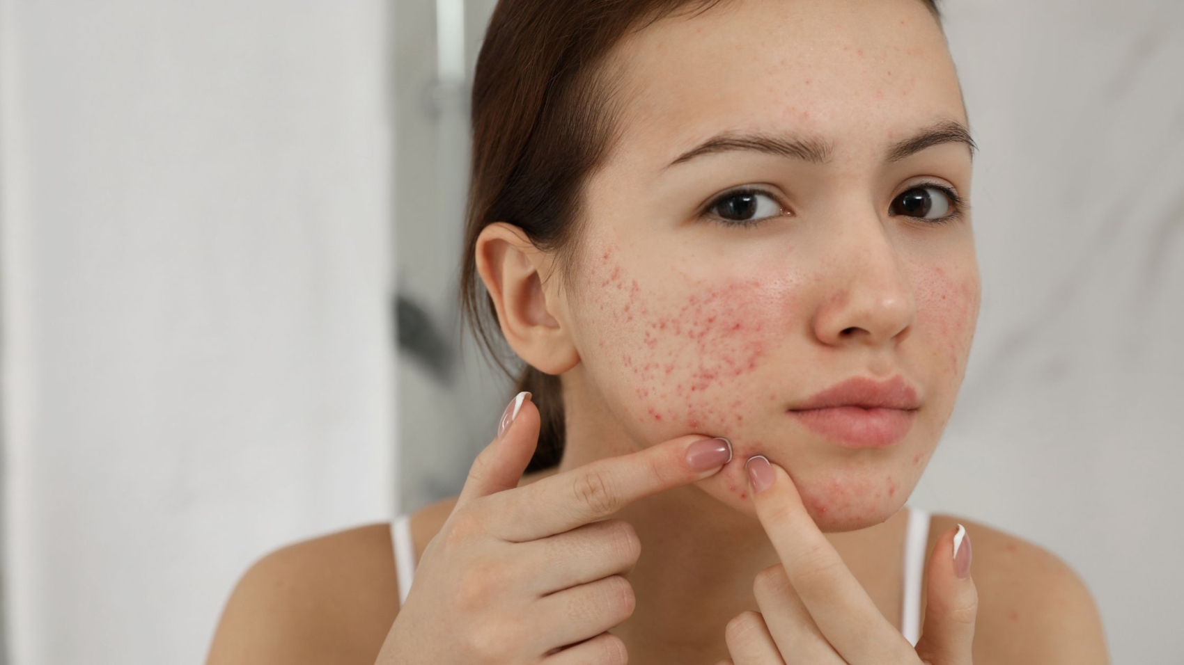 Acne Treatment: Causes, Solutions, and Expert Care for Clear Skin
