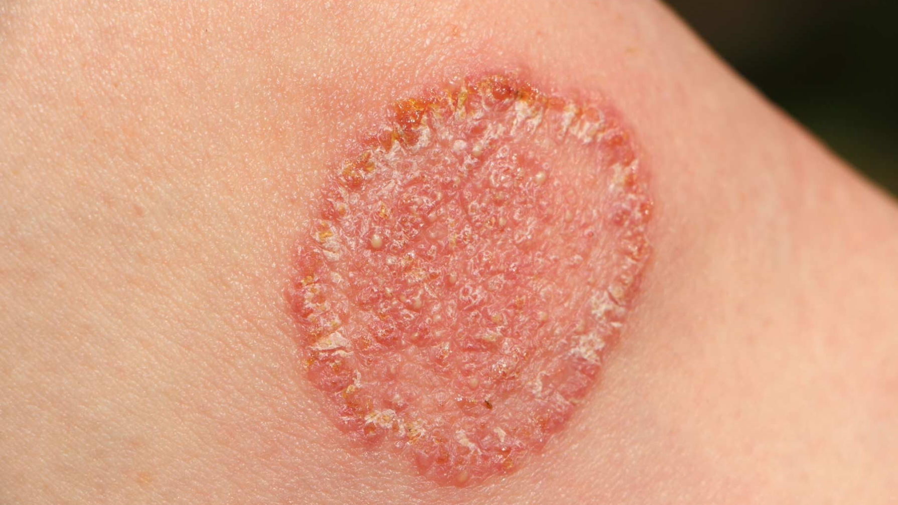 Fungal Infections: Causes, Symptoms, and Best Treatment Options | CoLaz ...